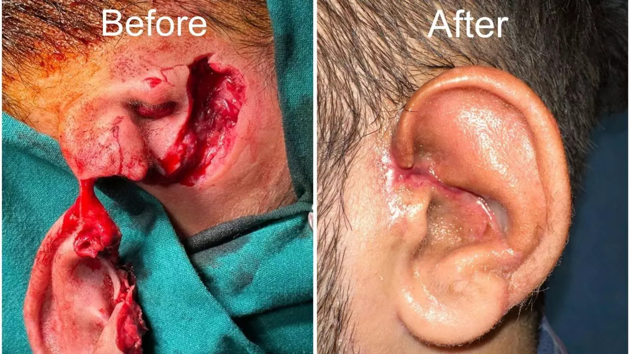 Pet Pitbull Bites Off 22-Year-Old Man’s Ear, Doctors Successfully Performs 11-Hour Reconstructive Surgery