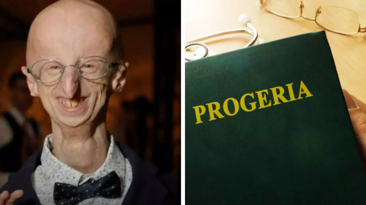 Sammy Basso the Longest-Living Survivor Of Progeria Does At 28