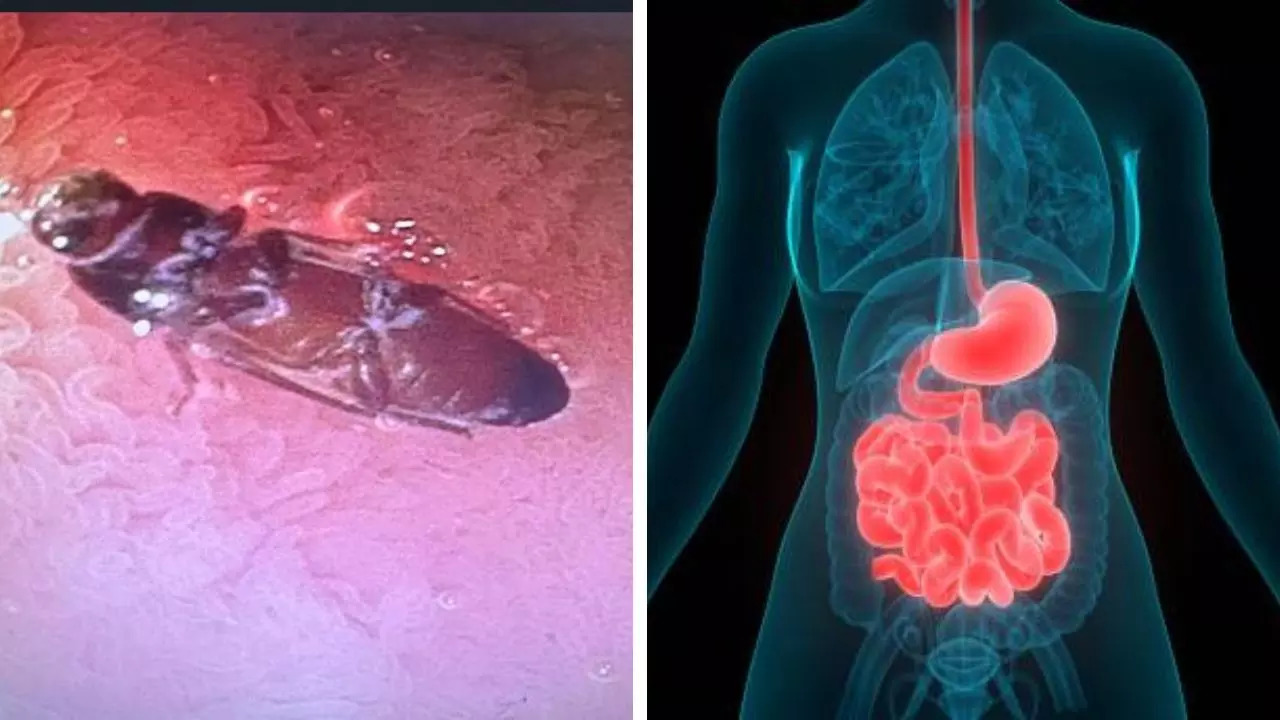 Delhi Doctors Remove 3cm-long Live Cockroach From A Young Man's Intestine 