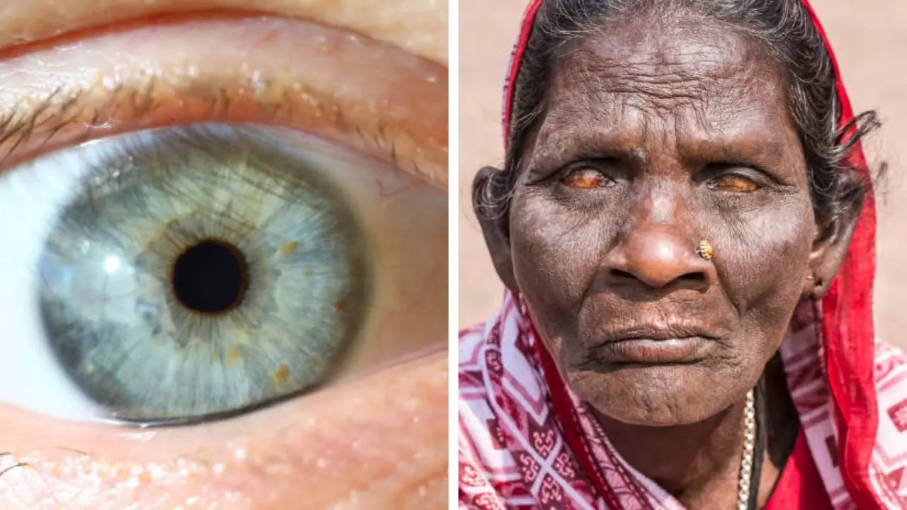 WHO Declares India As Trachoma Free