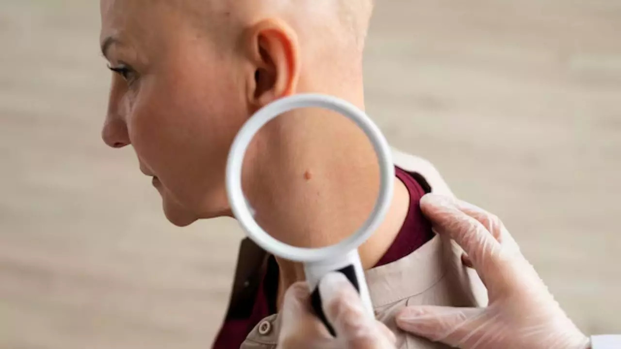 Are Skin Tags A Sign Of Breast Cancer? Expert Says THIS