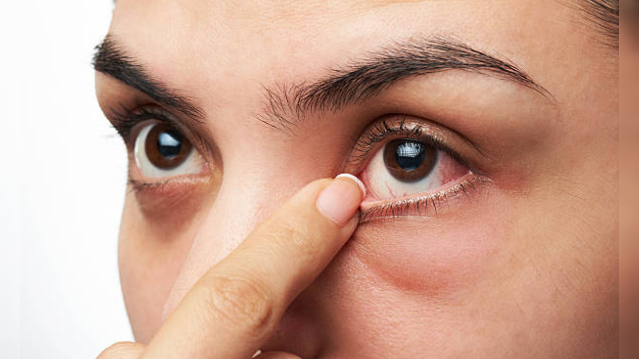 remove an eyelash from eye safely with these steps