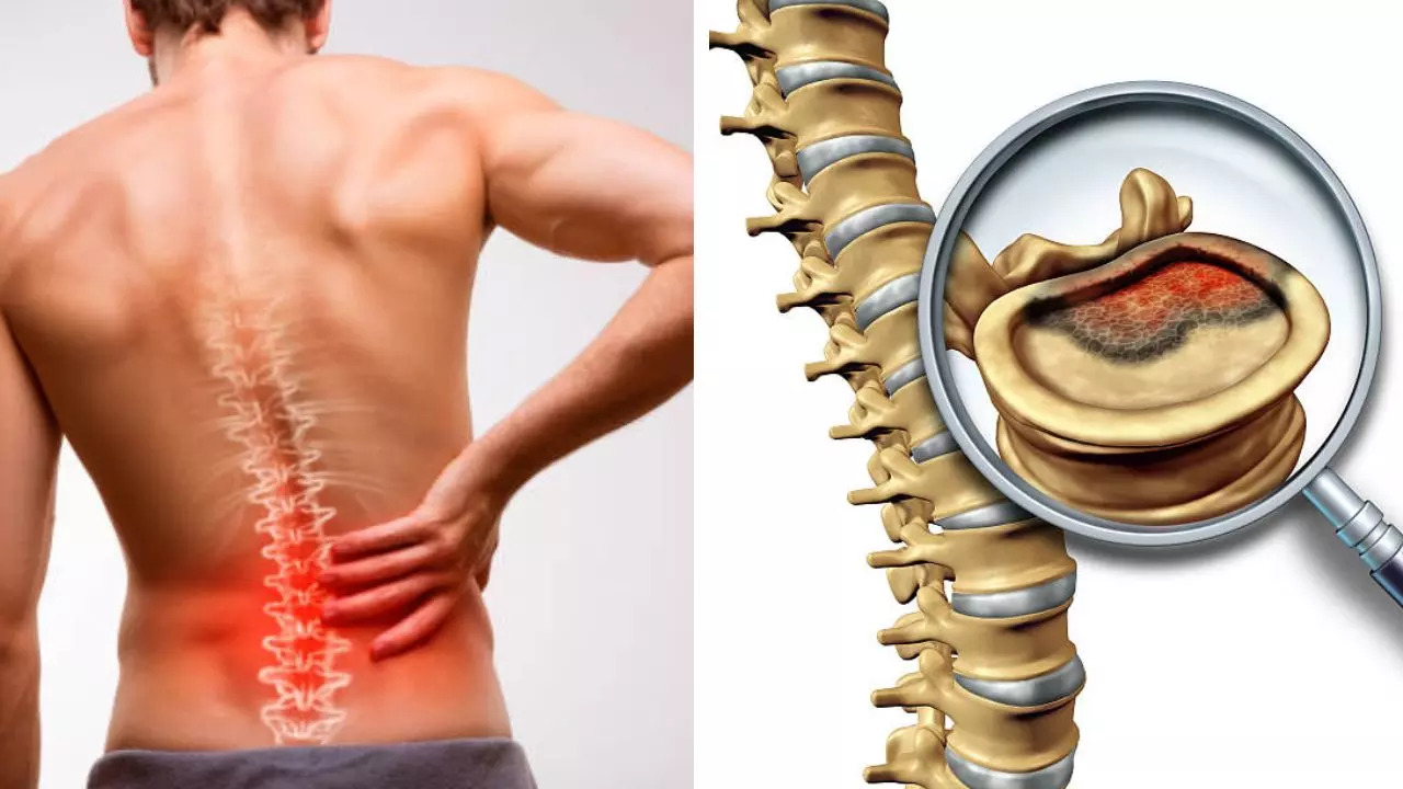 Could My Back Pain Be Spine Cancer; Ways To Recognize Spinal Tumours 