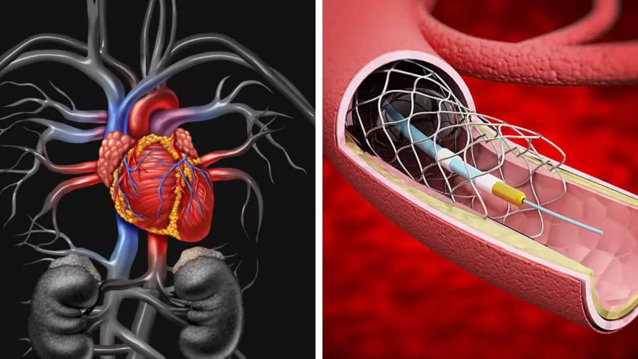 US FDA Approves New Heart Stents For Infants and Children Born With Congenital Heart Disease To Avoid Series Of Surgeries   