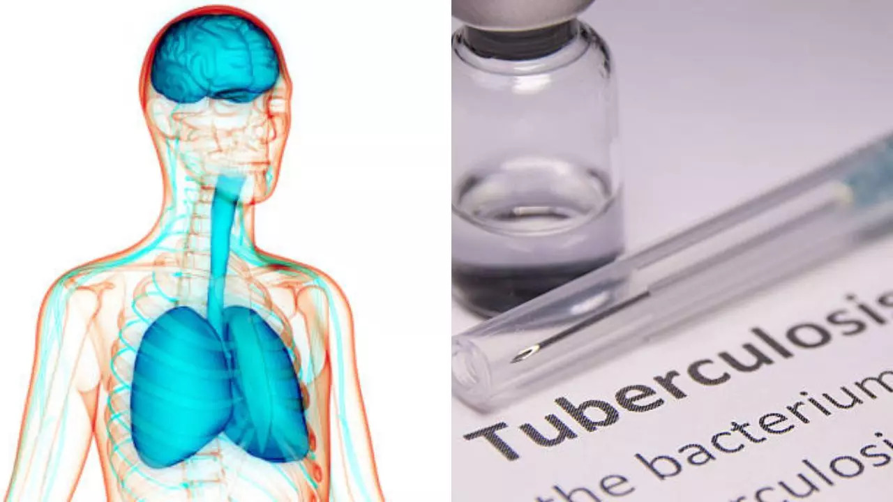 Indian Scientists Develop Breakthrough Method To Treat Brain Tuberculosis; Know All About It