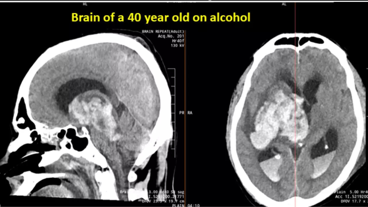 Brain Stroke Warning! The Liver Doc Shares Shocking Brain Scan Of 40-Year-Old Drinker