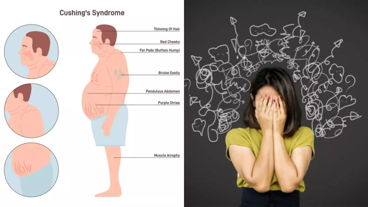 A hump between the shoulders could be due to high stress levels cushing's syndrome