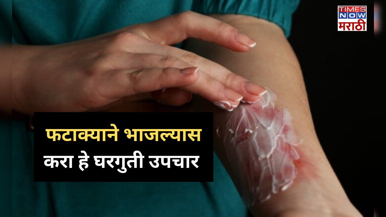 home remedies of burn due to firecrackers during diwali