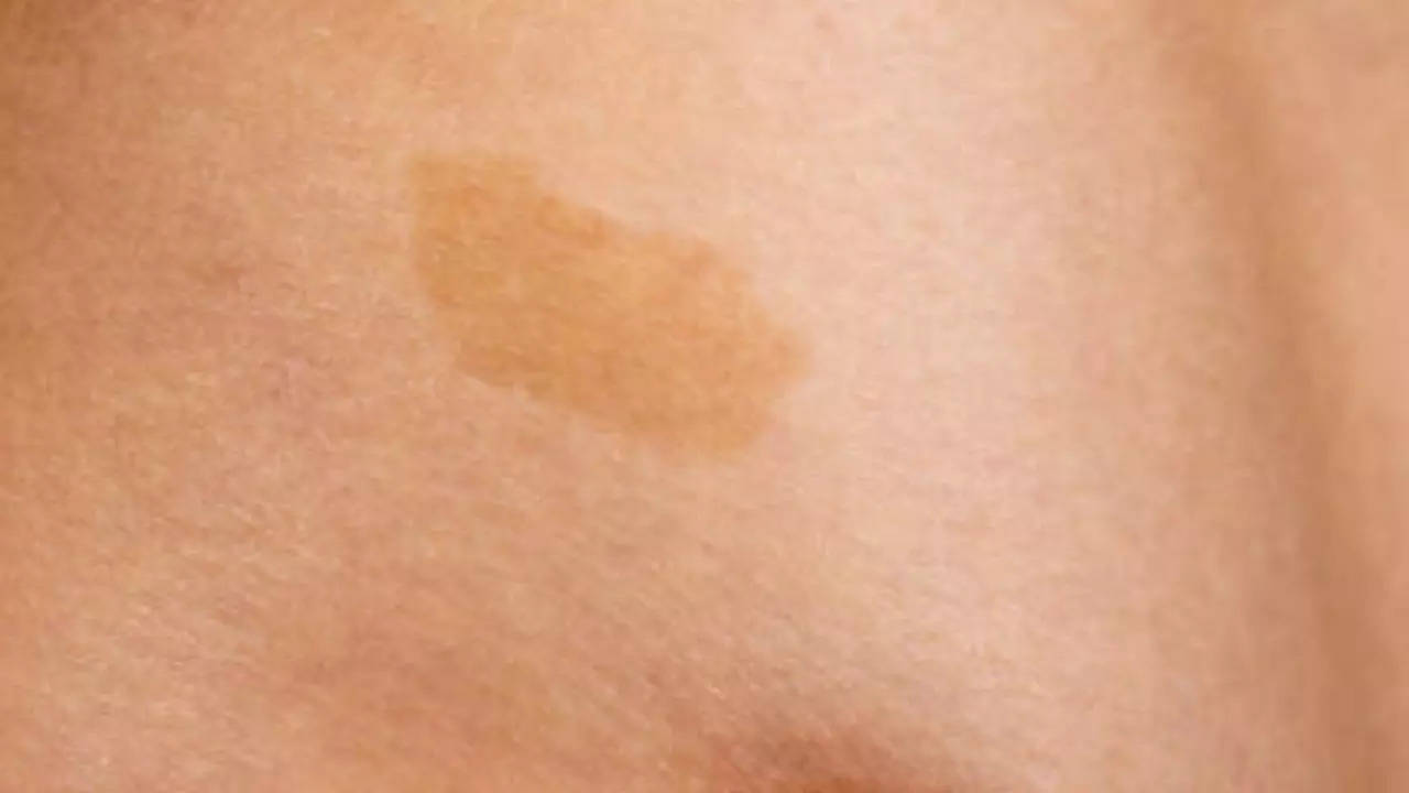 Birthmarks And Their Spiritual Meanings