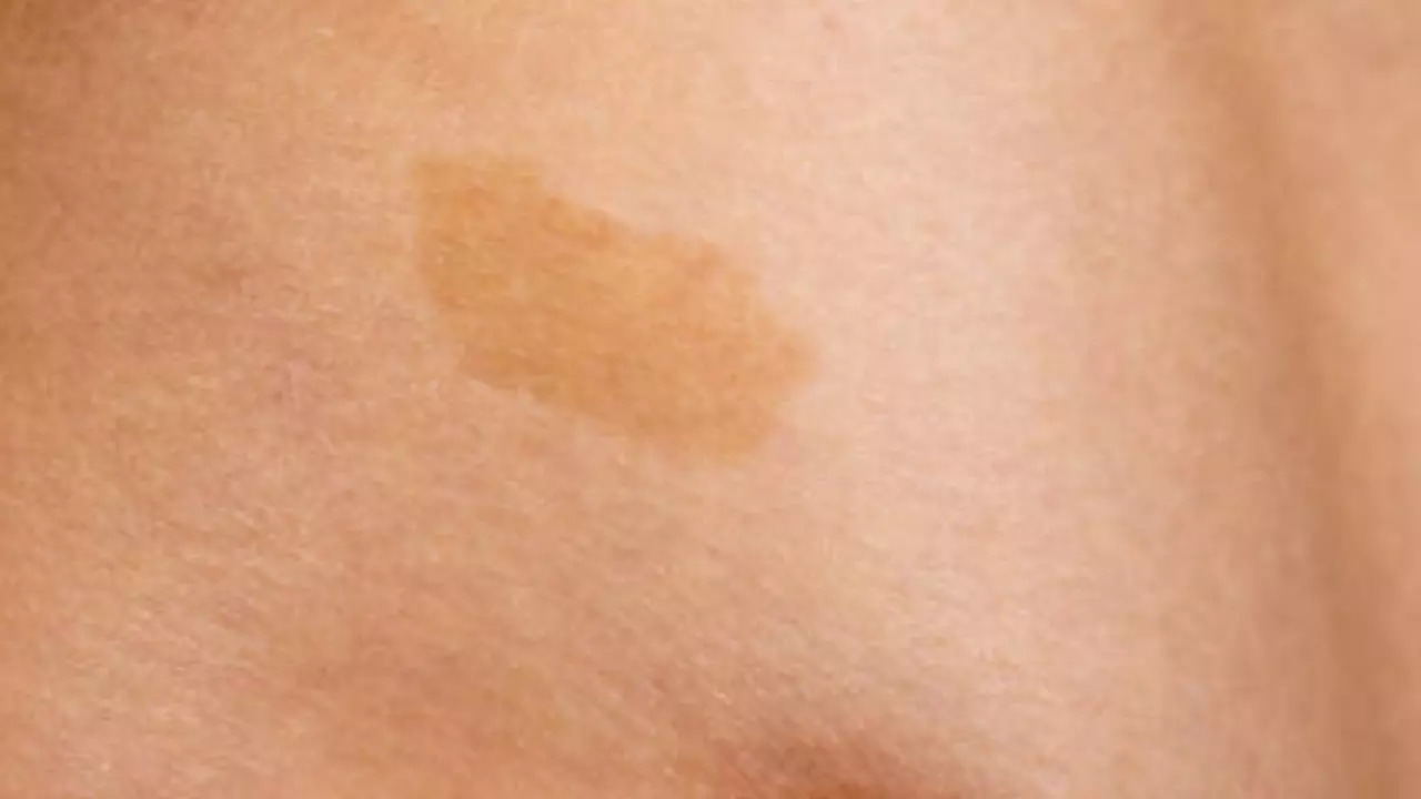 Birthmarks And Their Spiritual Meanings