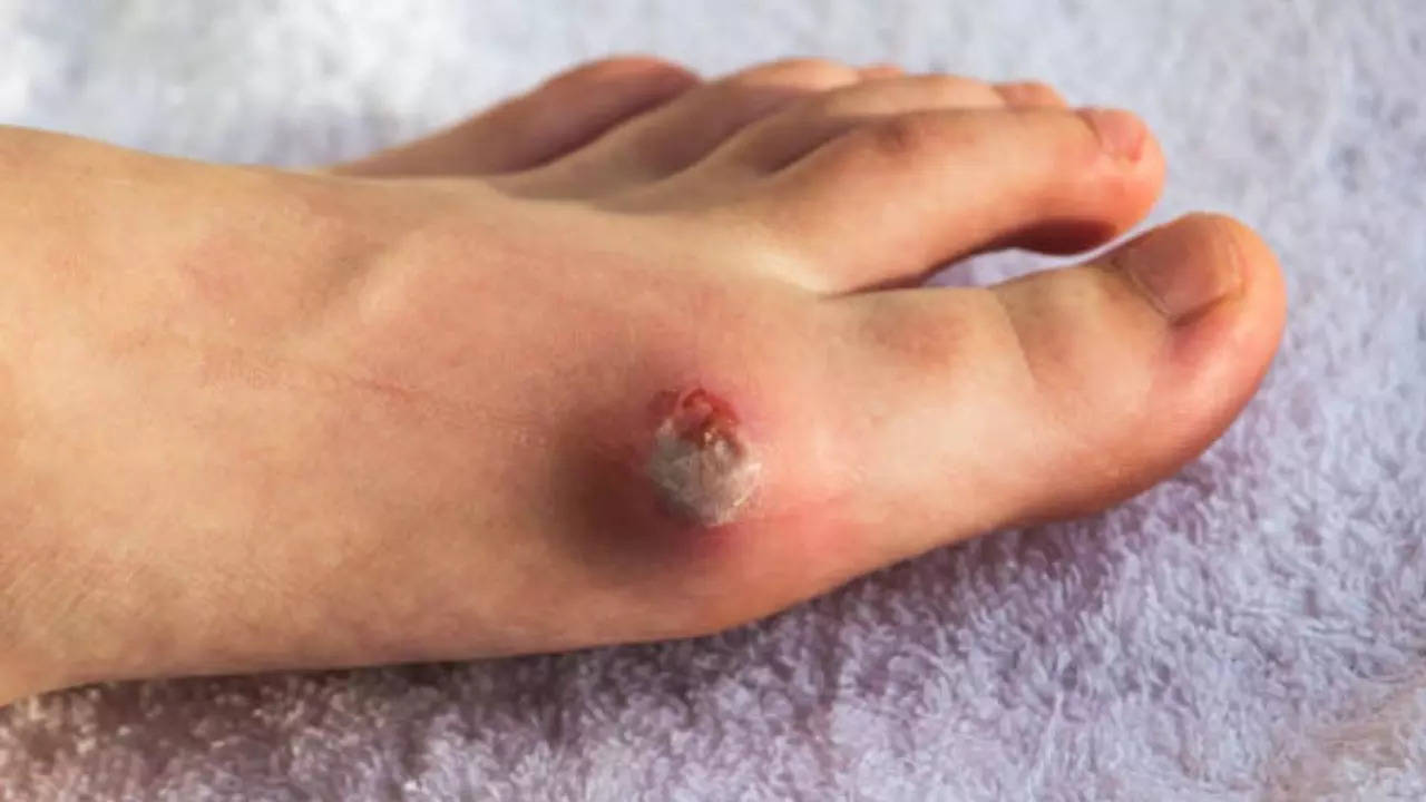 Why Diabetic Foot Ulcers Occur And How To Prevent Them: Expert Tips To Follow