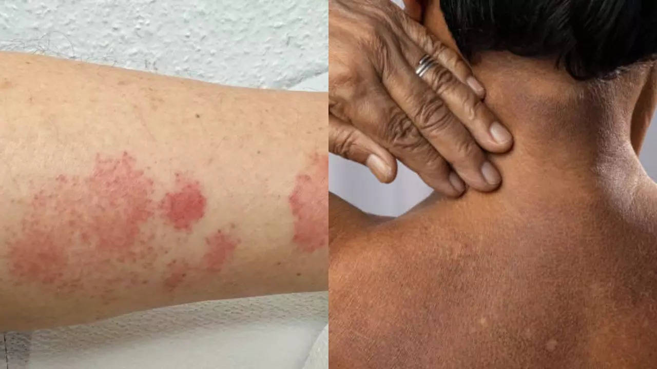 Doctors Report First US Cases of Sexually Transmitted Ringworm Rash  