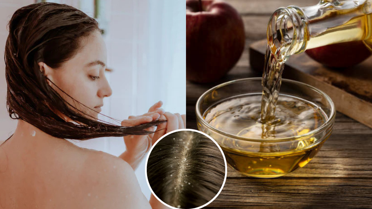 apple cider vinegar helps to get rid of dandruff