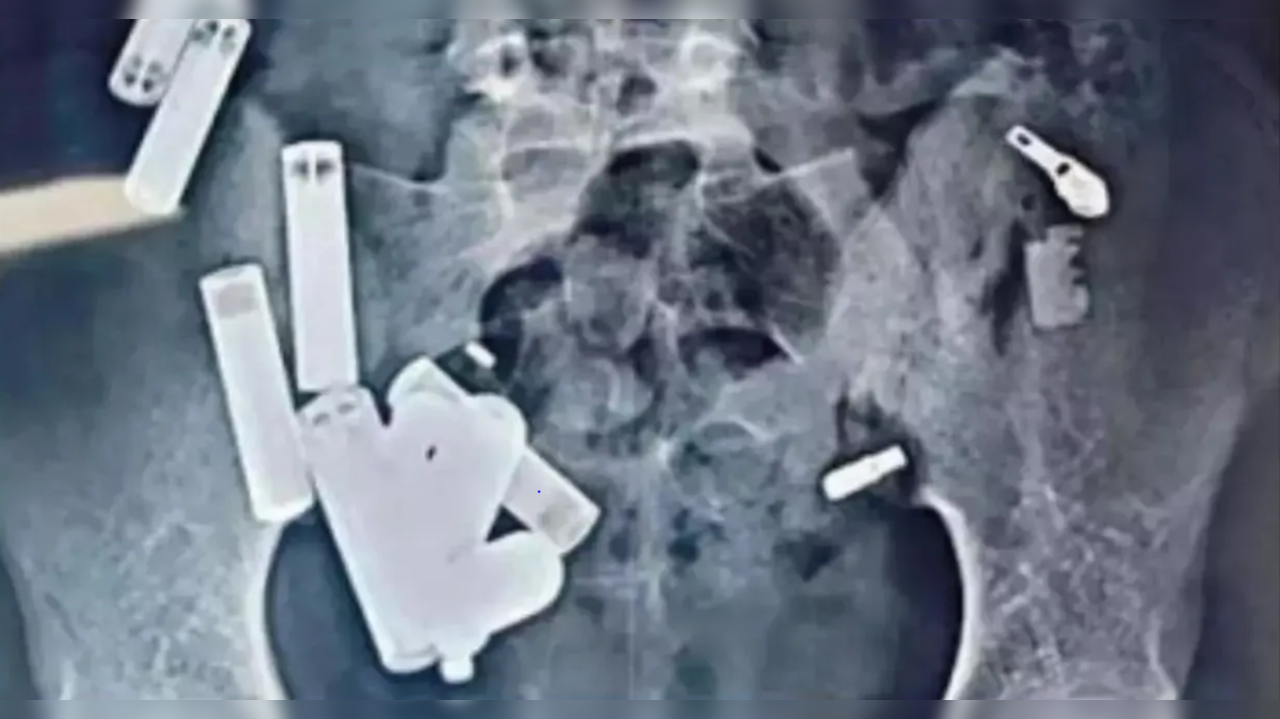 14-Year-Old Hathras Boy Dies After 65 Metal Objects Removed from Stomach