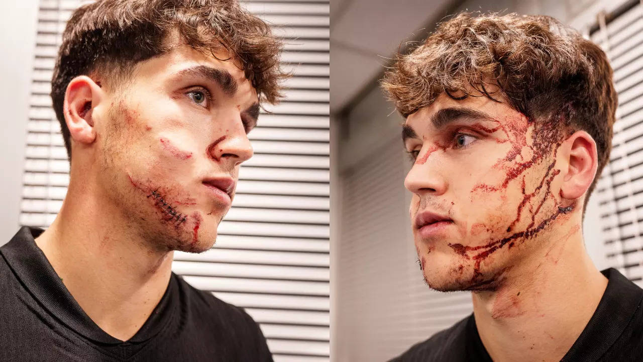 Bloodied Barcelona Youngster Pau Cubrasi Required 10 Stitches On Face After Getting Kicked In Champions League Game