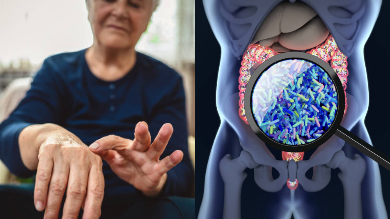 Changes In Gut Microbiome Can Be An Early Sign Of Rheumatoid Arthritis