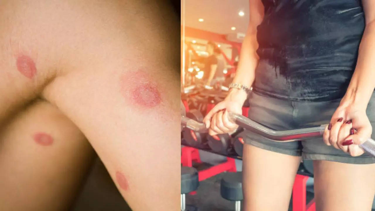 Beware! Your Gym May Be Giving You Ringworms, Know How This Dangerous Skin Infection Spreads  