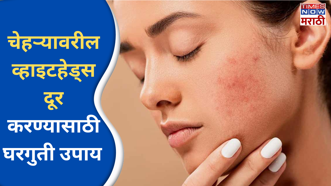 skin care tips home remedies for whiteheads in marathi