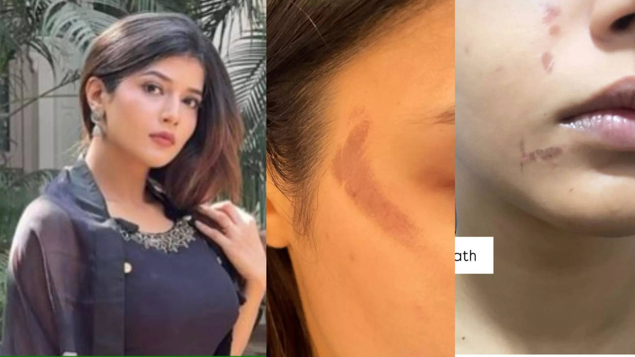 YRKKH’s Samridhii Shukla Shares Disturbing Face Burn Photos And Video From Her On Set Mishap