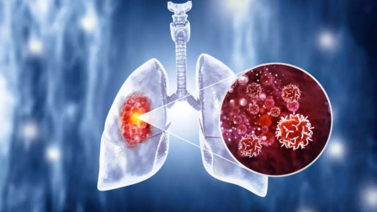 In the last five years, the lung cancer survival rate has improved by 26 per cent