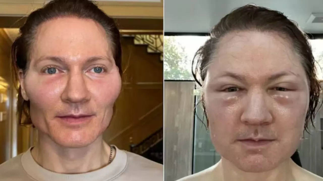 Bryan Johnson looks unrecognisable after a recent anti-aging procedure.