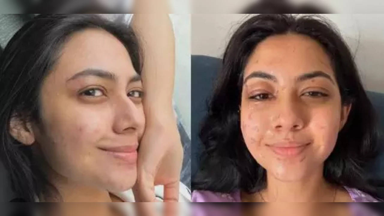 Reem Shaikh Reveals Parents Didn't Want Her To Post Half-Burnt Face Pics: Producers Won't Call For Work