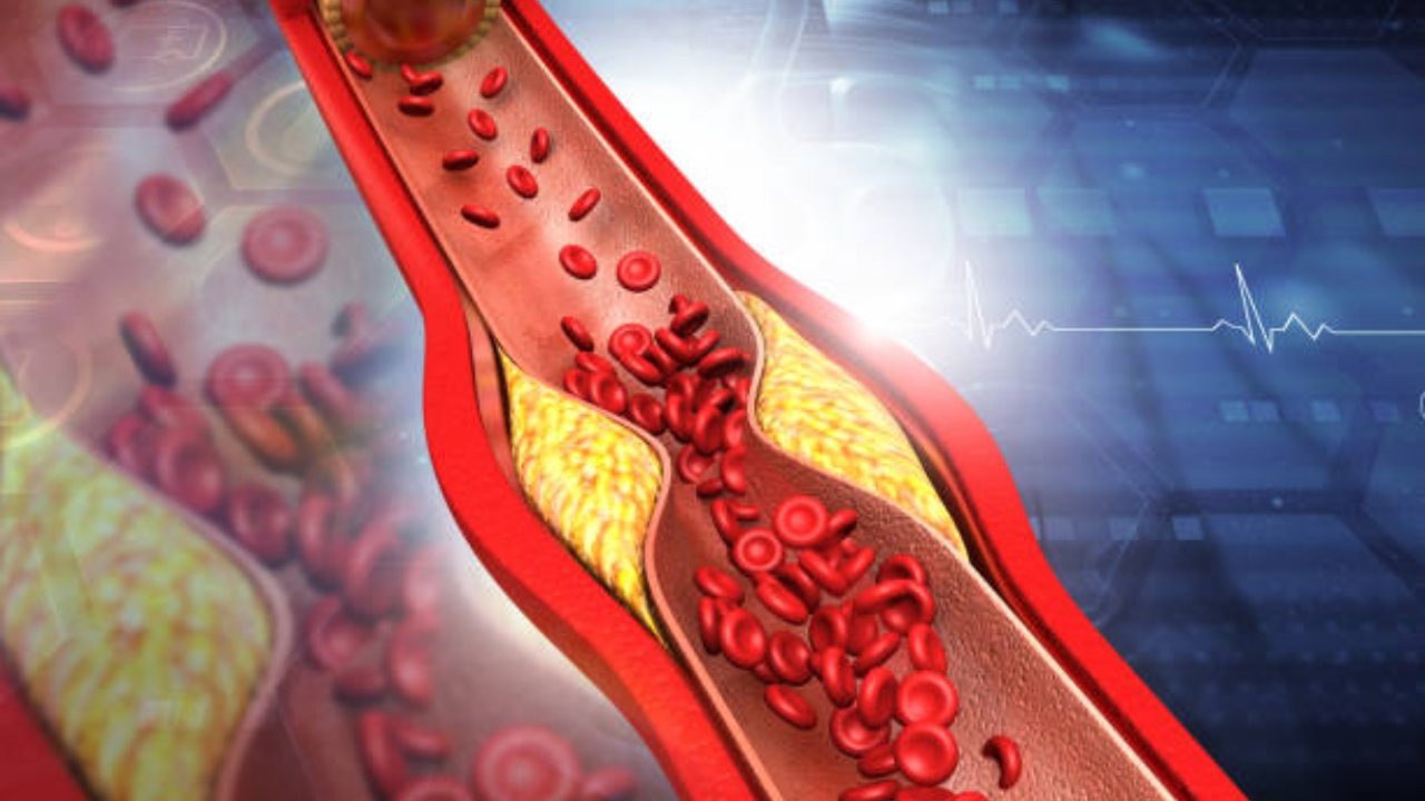 CDC Says Nearly 1 in 10 U.S. Adults Has High Cholesterol