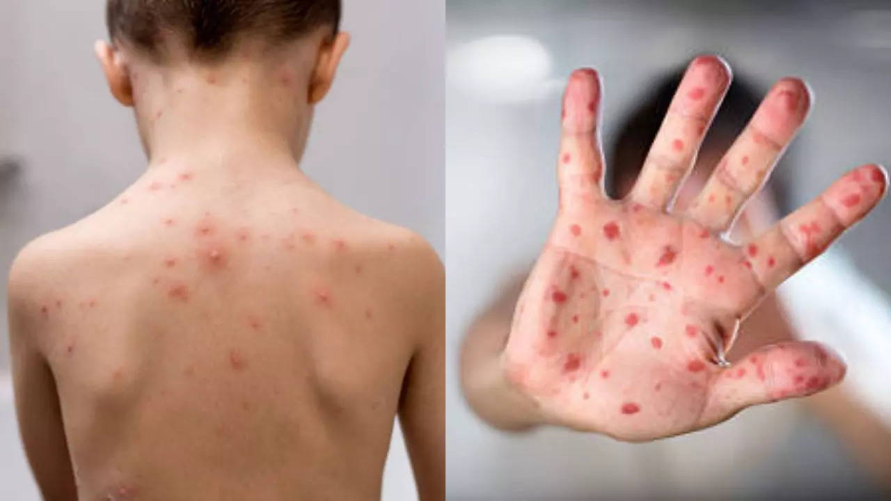 All about The Risk Factors And Symptoms Of Chickenpox Virus  