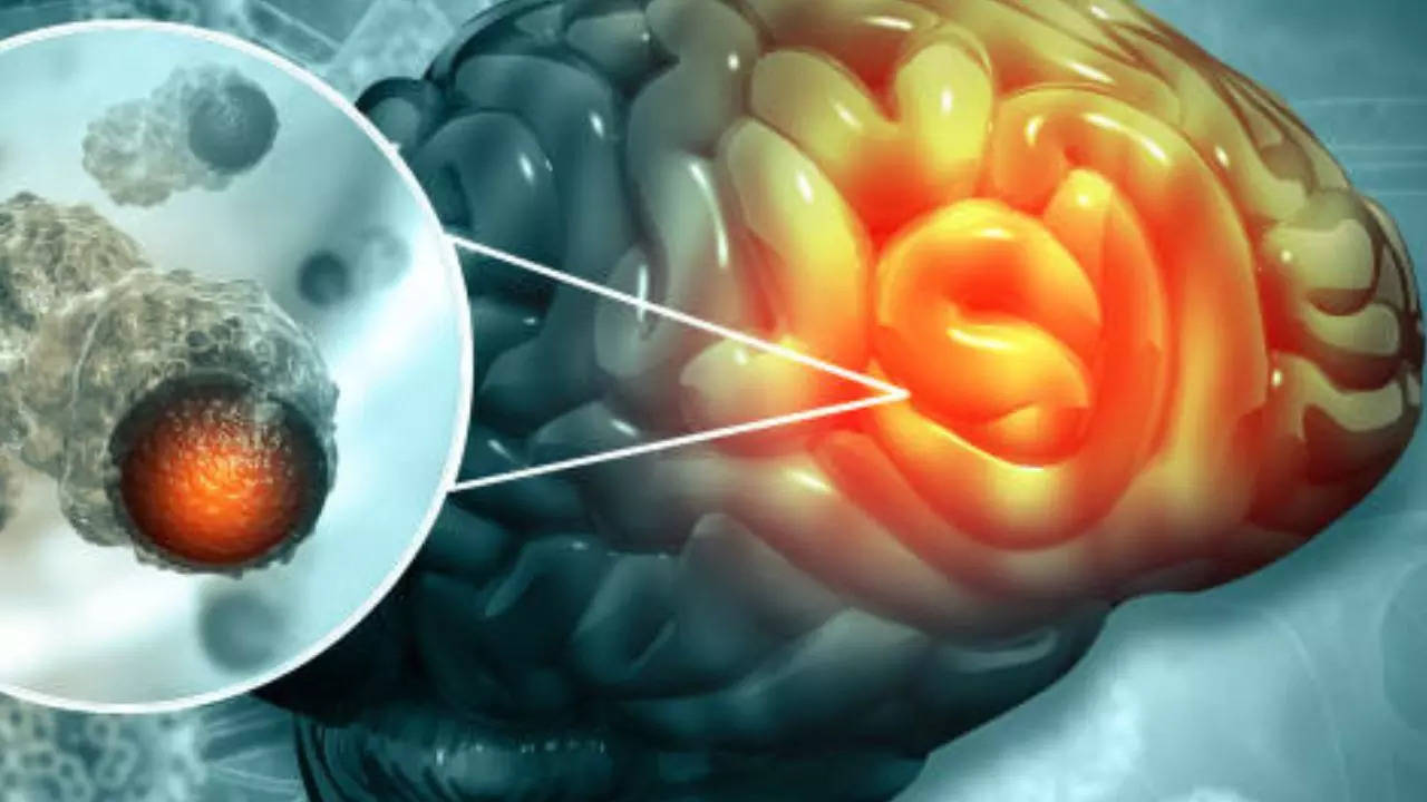 How Neurosurgeons Are Treating Brain Tumors Without Major Incisions  