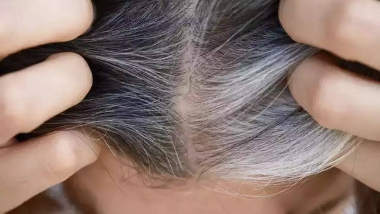 White Hair Causes And Remedies