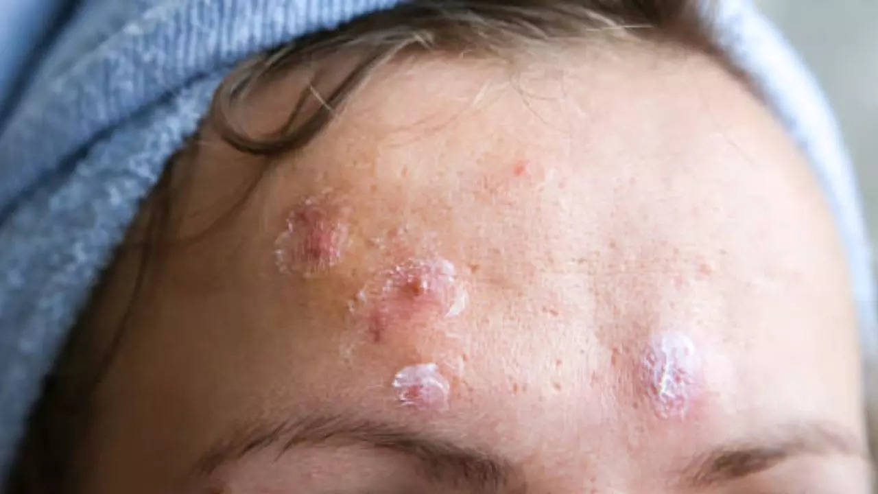 Woman's Harmless Pimple Becomes Deadly Cancer Within Two Years