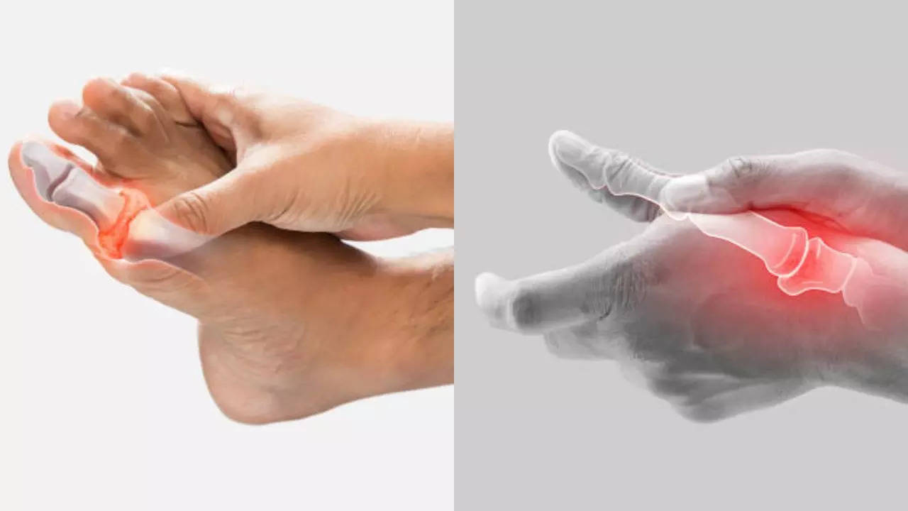 Red Flag Symptoms of High Uric Acid That Appear In Your Hands and Legs  