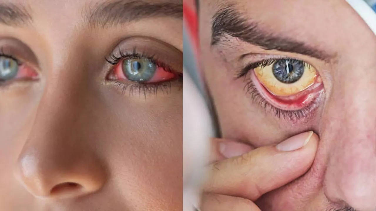 Warning Signs of Heart Attack That Appear In Your Eyes Before A Month  