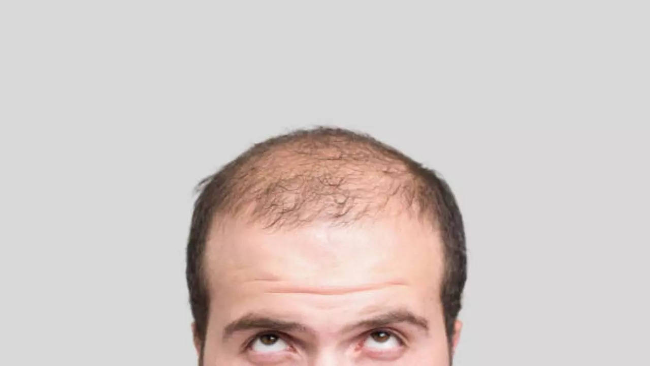 Can You Regrow Hair On A Bald Spot, Yes, Here's How  