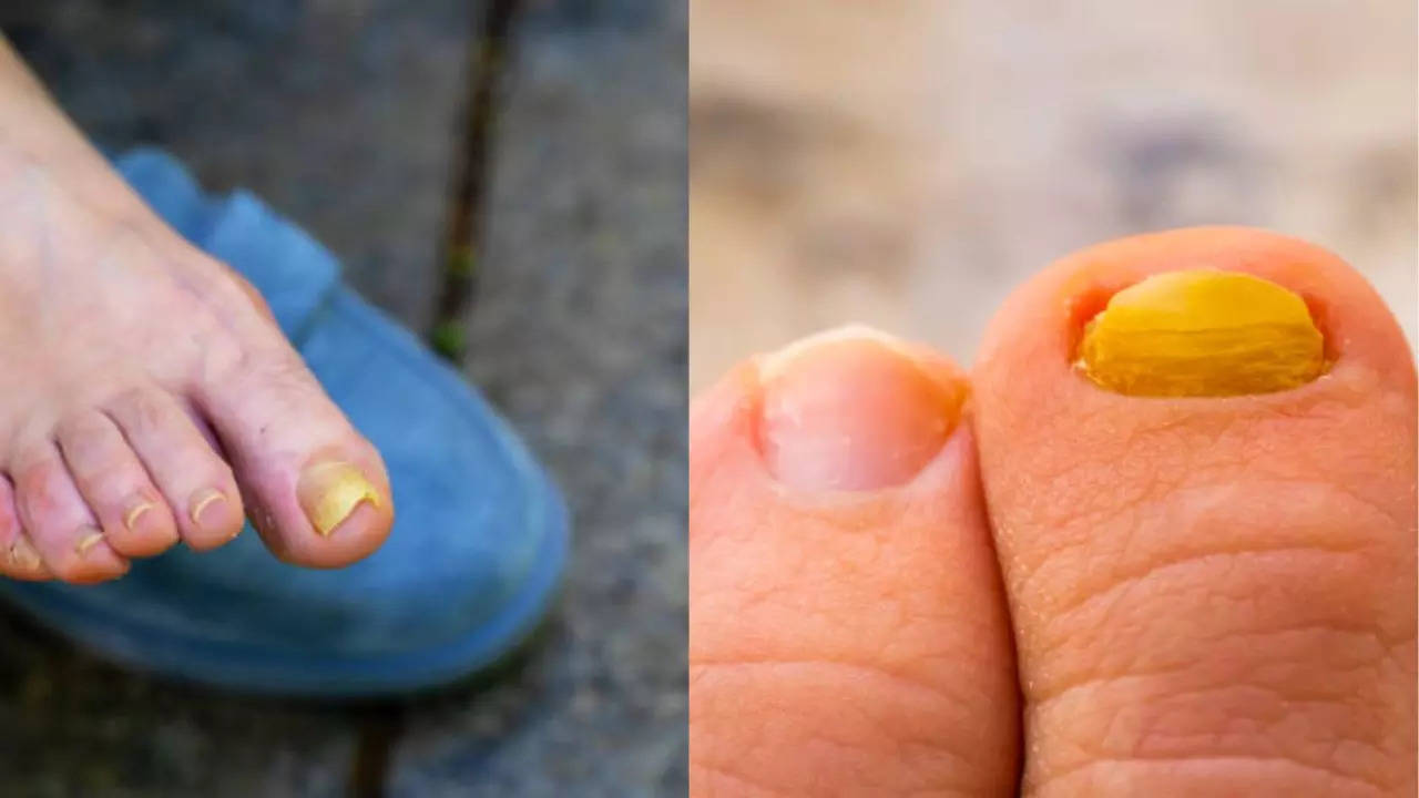 Yellow Nails Could Be A Warning Sign of THIS Deadly Condition Causing Breathlessness  