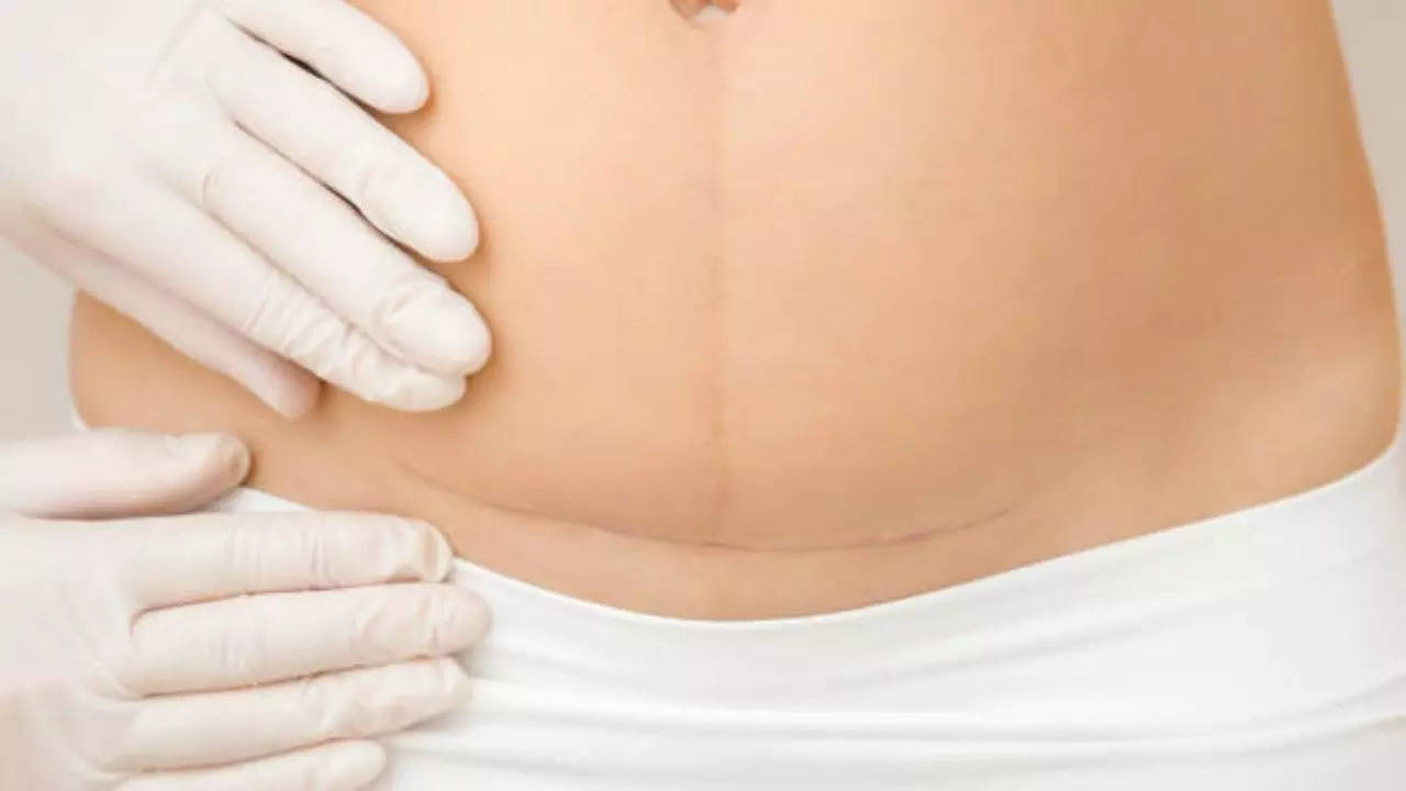 Myths about cesarean section that you need to know