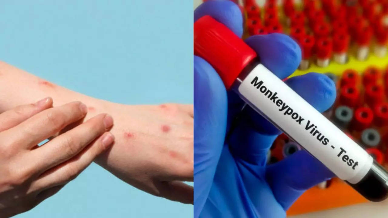 First Mpox Case Reported In Serbia’s Kosovo Region—Here’s What You Need To Know