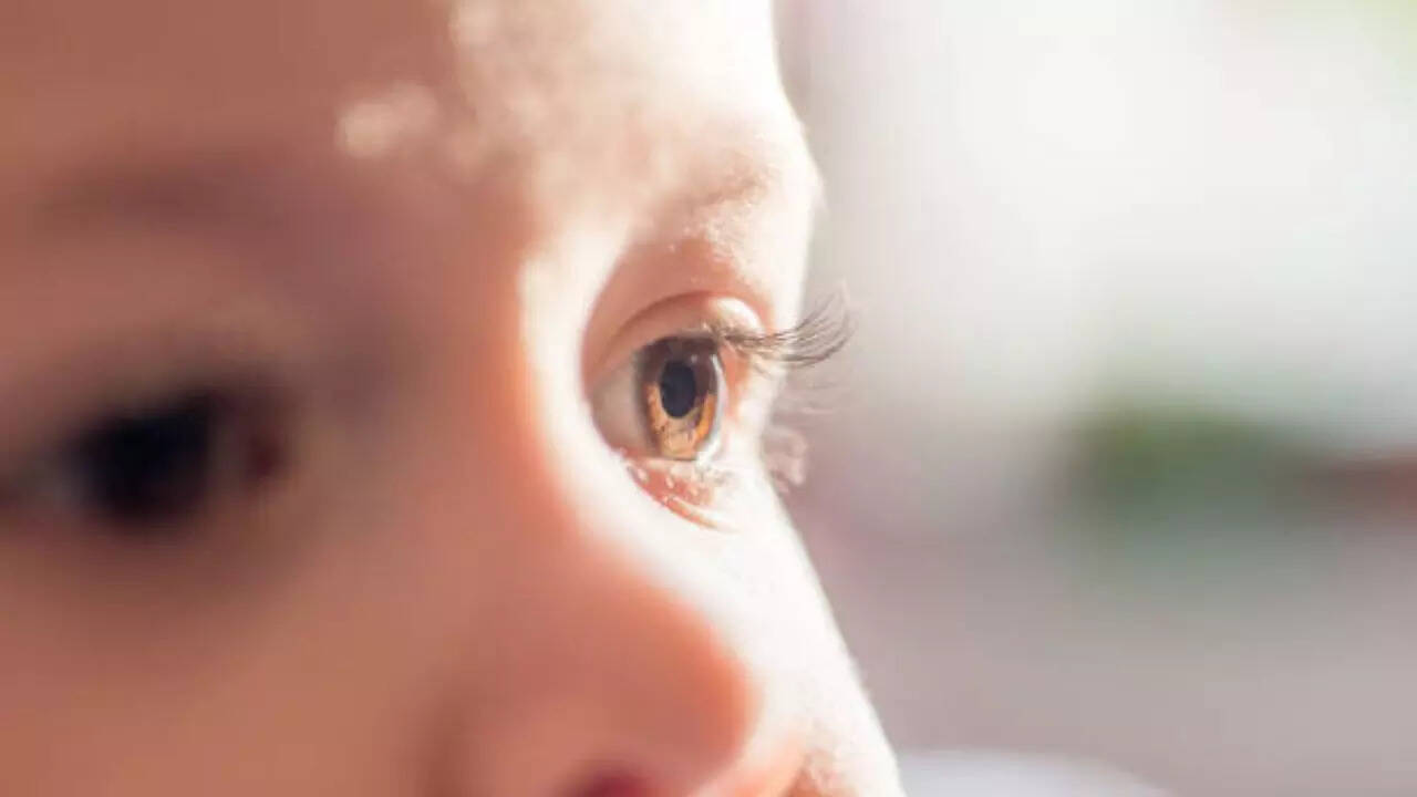 Cataract Cases on the Rise Among Infants, ways to Prevent Your Child From Going Blind  