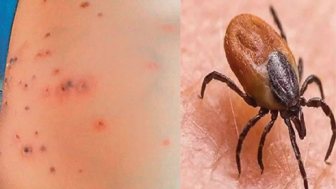  வேகமாக பரவும் ஸ்க்ரப் டைபஸ் நோய் தொற்று.. சென்னை உள்ளிட்ட இந்த 7 மாவட்டங்கள் கவனம்.. சுகாதாரத்துறை எச்சரிக்கை 