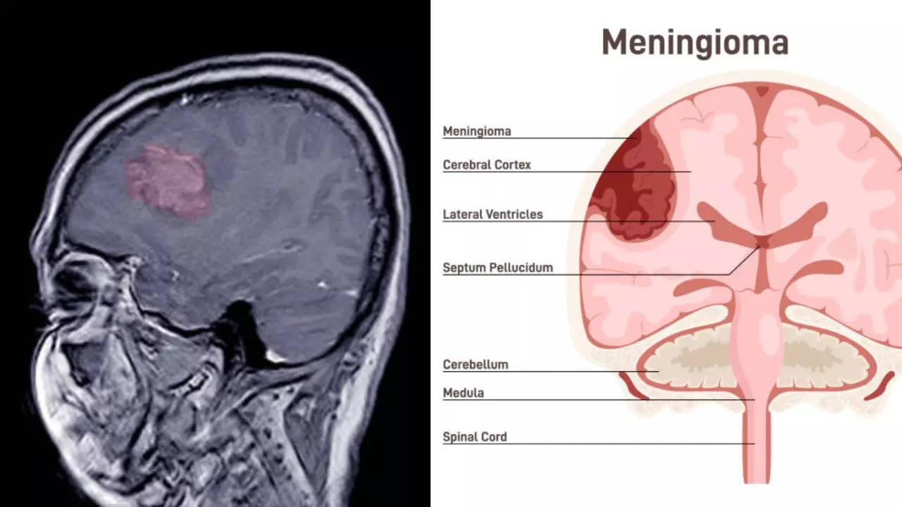 Woman Diagnosed With Killer grade 2 meningioma After Not Being Able to Read A Single Letter During Her Eye Test  