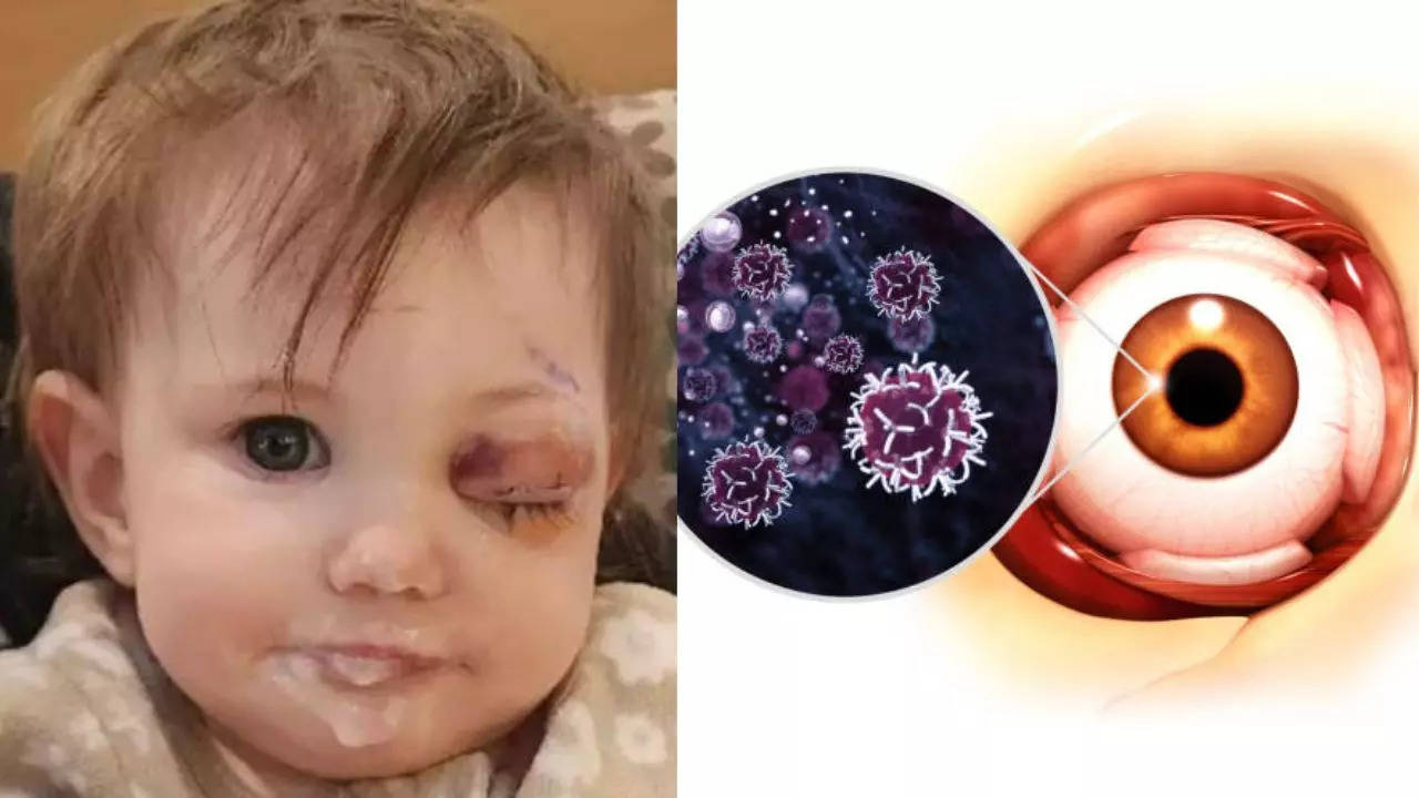 A Year-old Child Loses An Eye To Rare Cancer After Swelling