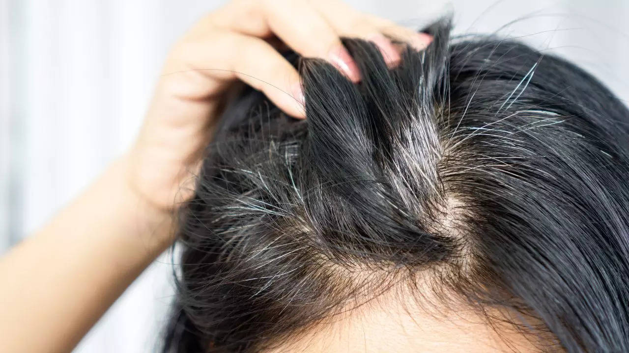 White hair problem here some home remedies to repair your white hair