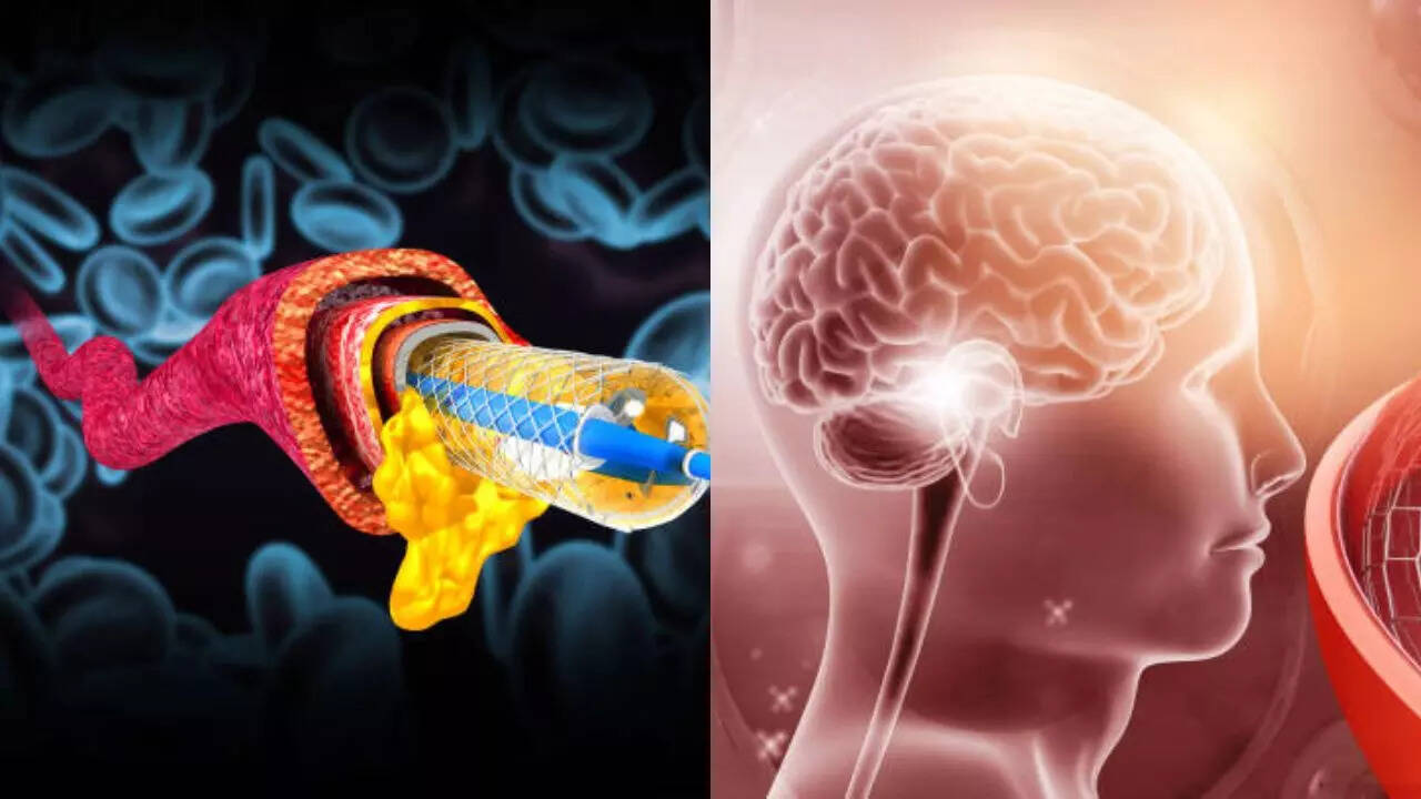 Brain stents: Gamechanger in preventing major strokes, experts say completely safe