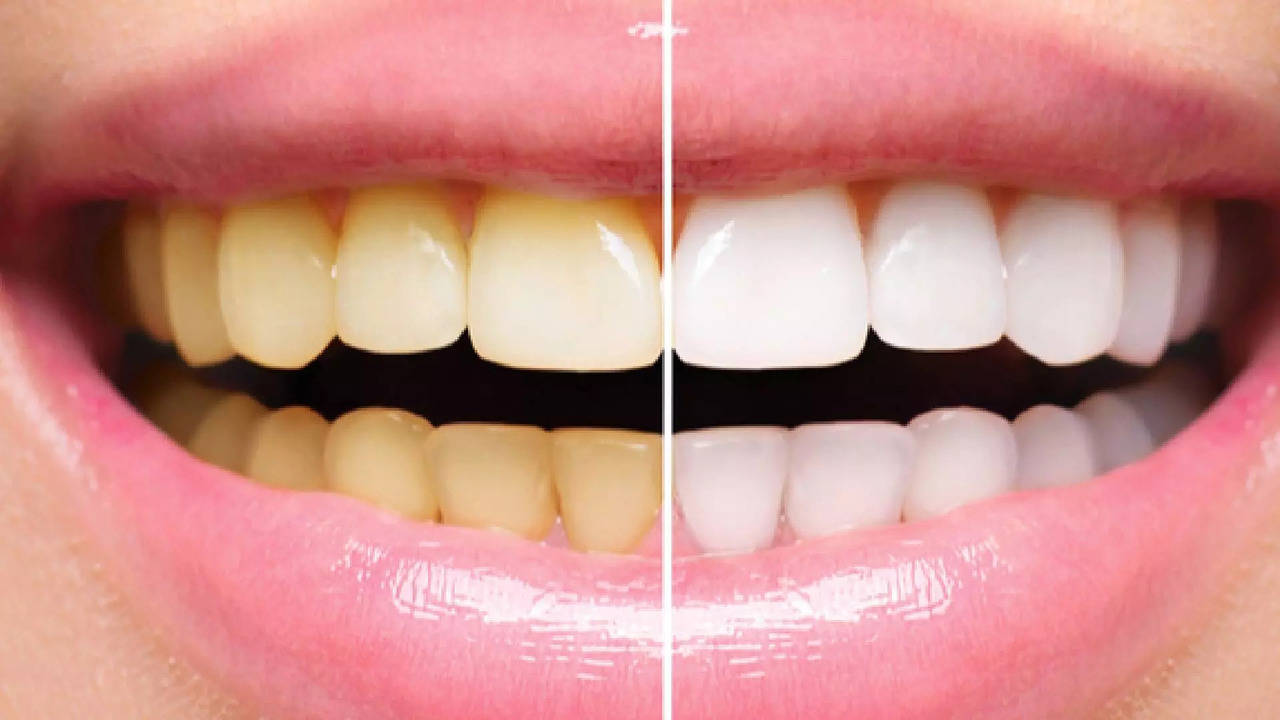 struggling with yellow teeth? try these effective home remedies for pearly whites