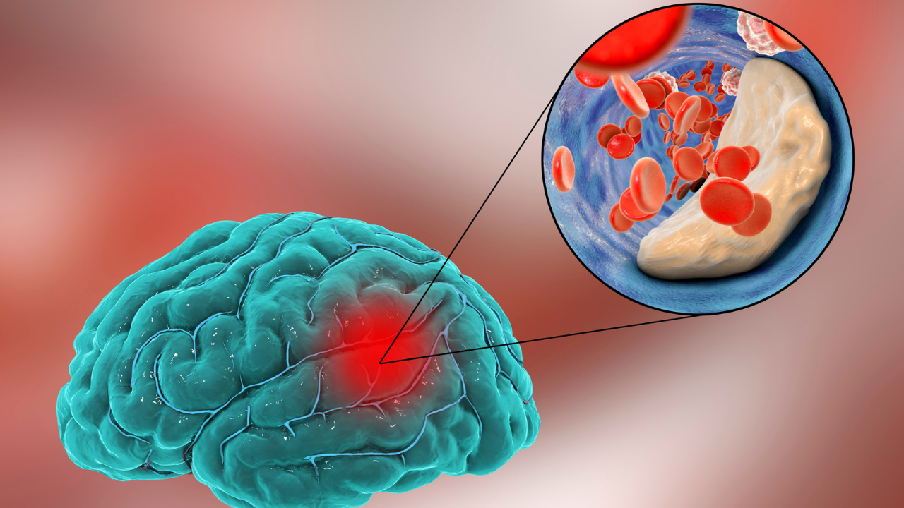 pune reports 22 suspected cases of rare disorder guillain-barré syndrome; what is it?