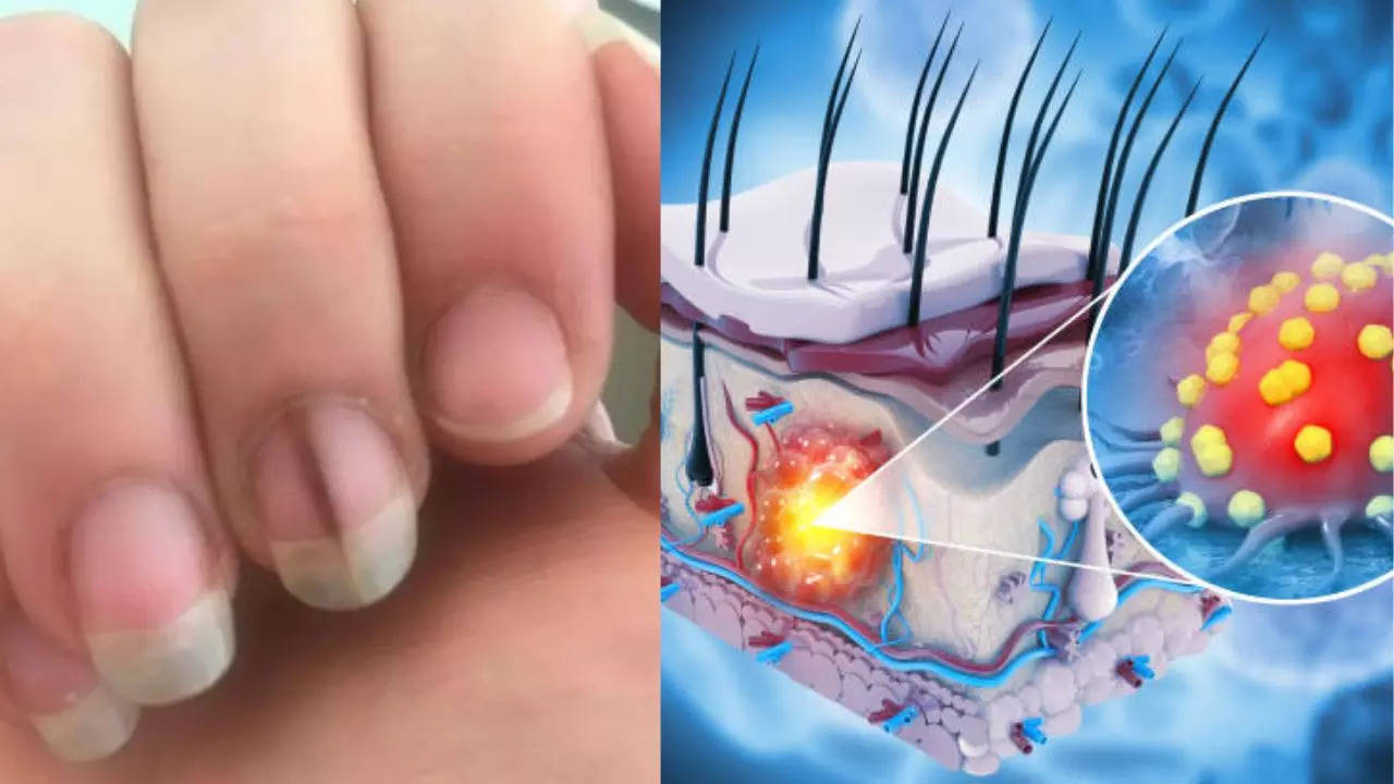 Woman's Unusual Nail Was The First Sign of Stage 4 Terminal Cancer, Since Then It Has Returned Aggressively Thrice, Know How Melanoma Spreads