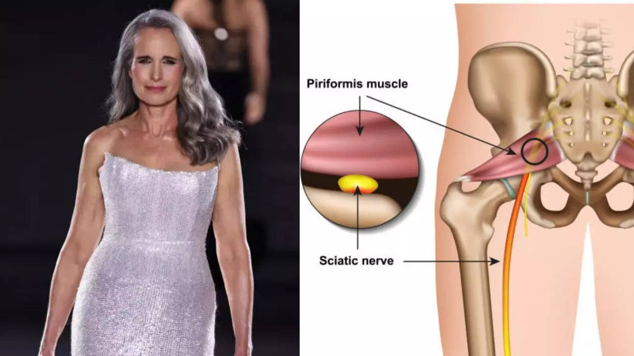 What is Piriformis Syndrome, a painful neuromuscular condition that Andie MacDowell struggles with? Is it different from sciatica?