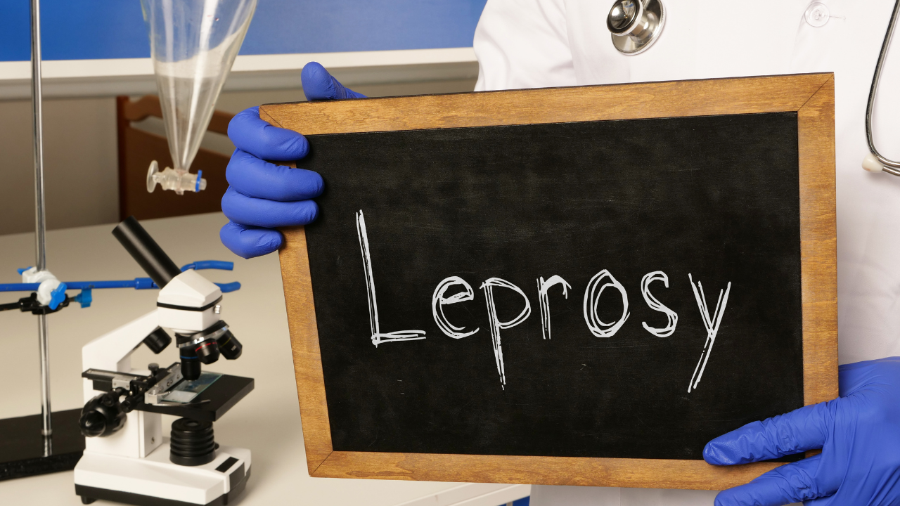 Leprosy busted: Expert debunks common myths and reveals the facts behind this misunderstood disease