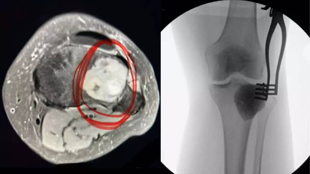 The woman shares the initial signs of one million tumors that ‘eat her bones’; Everyone knows about osteoclastoma