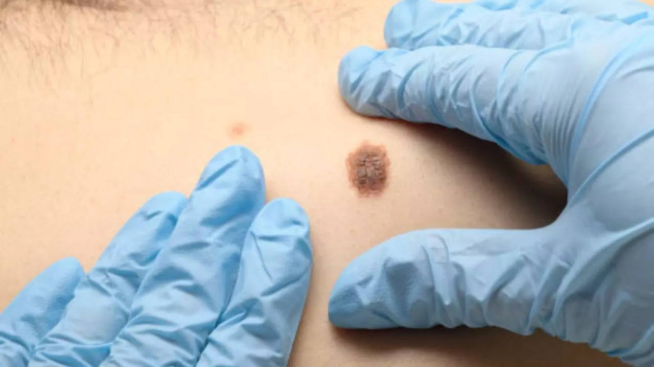 Skin Cancer Warning: 5 Signs You Should NEVER Ignore!